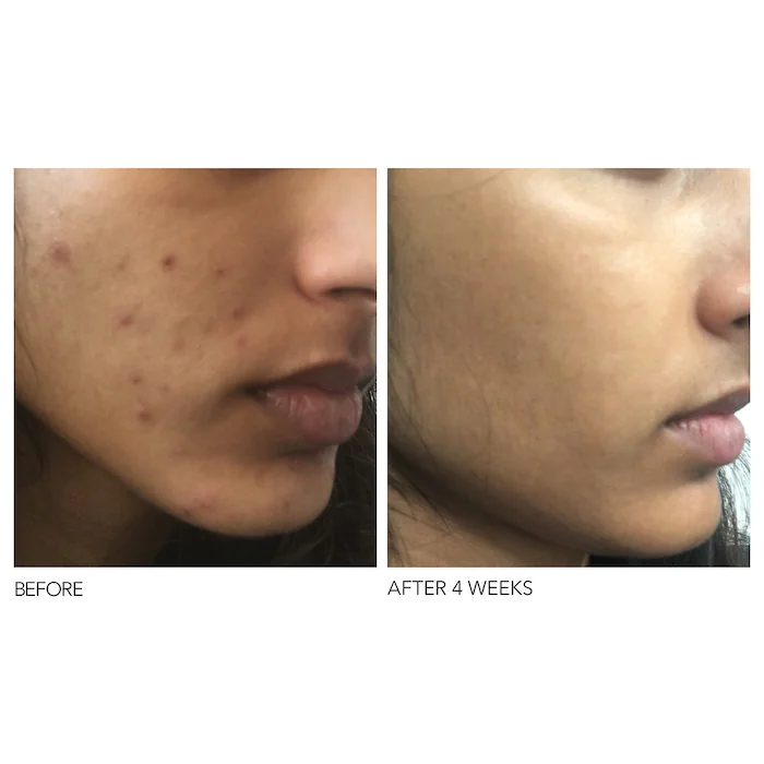 Mini Alpha Beta® Extra Strength Daily Peel